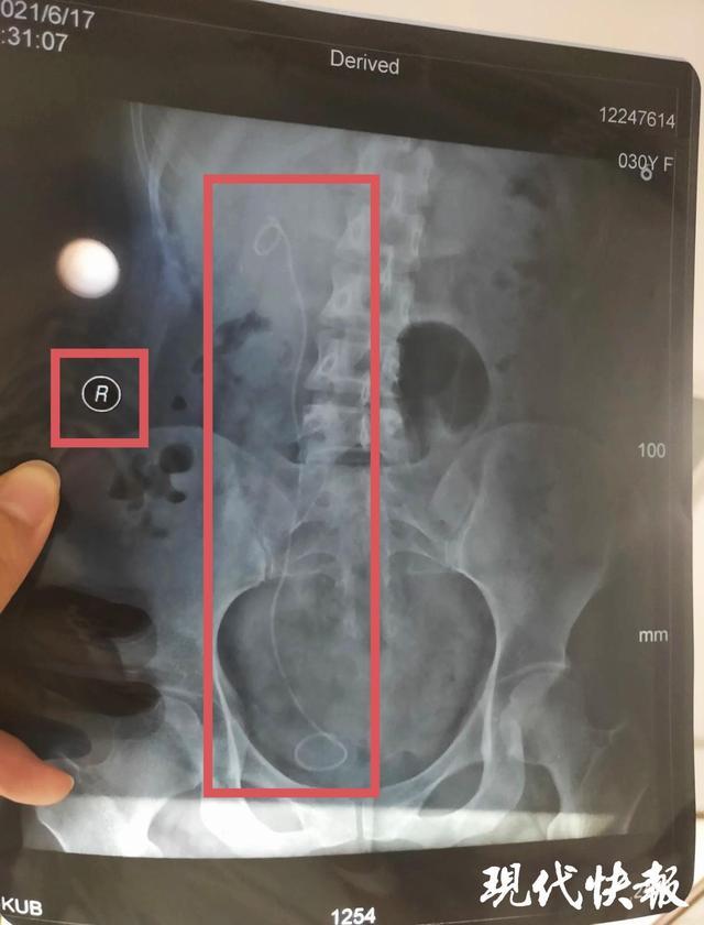 醫生左右不分把支架裝進正常輸尿管三名醫生醫療事故僅處罰一助手(圖2)